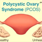 polycystic ovarian syndrome