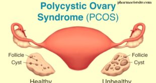 polycystic ovarian syndrome