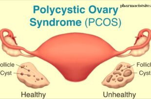 polycystic ovarian syndrome