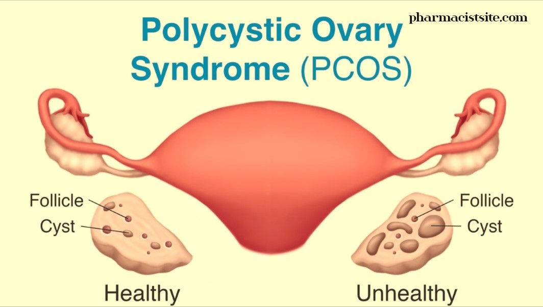 polycystic ovarian syndrome