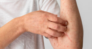 winter rash-pharmacistsite.com