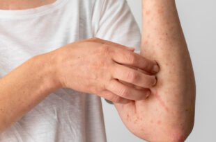 winter rash-pharmacistsite.com