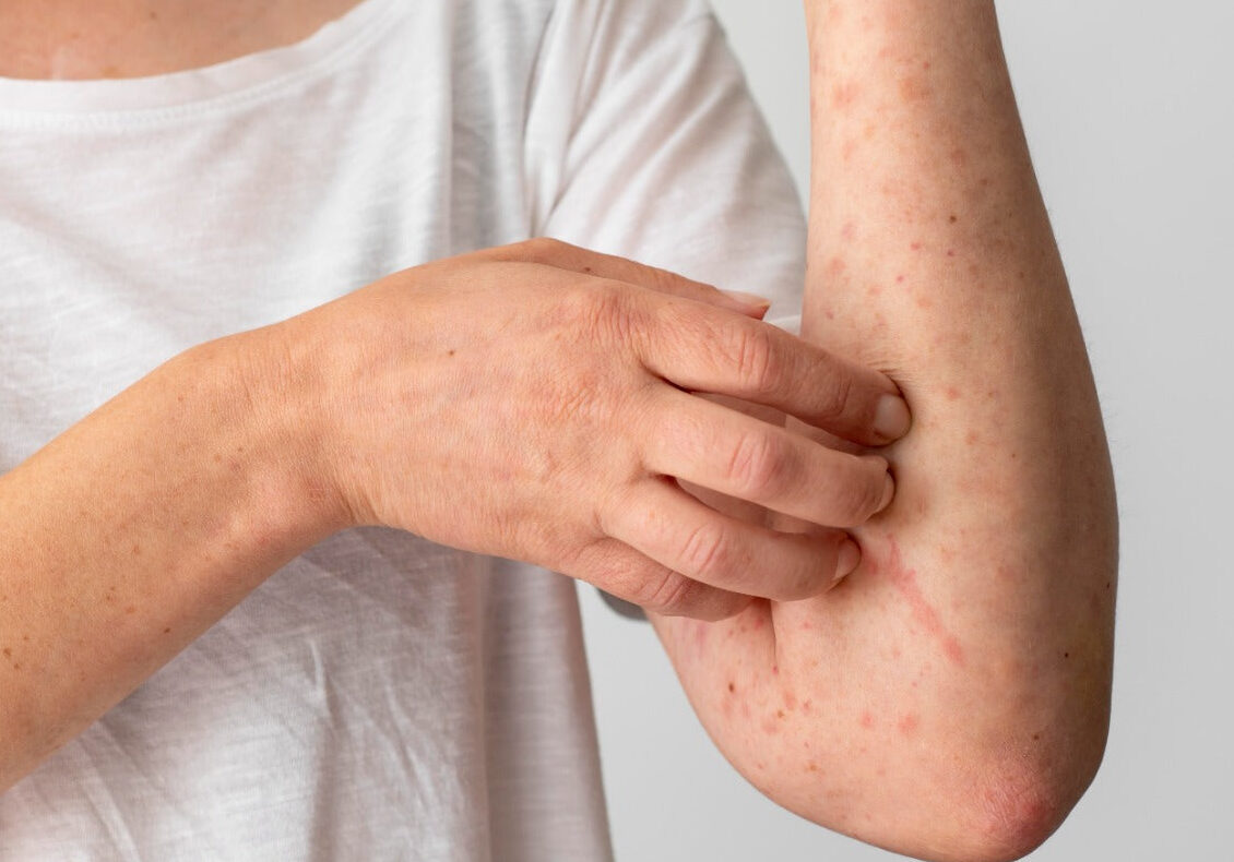 winter rash-pharmacistsite.com